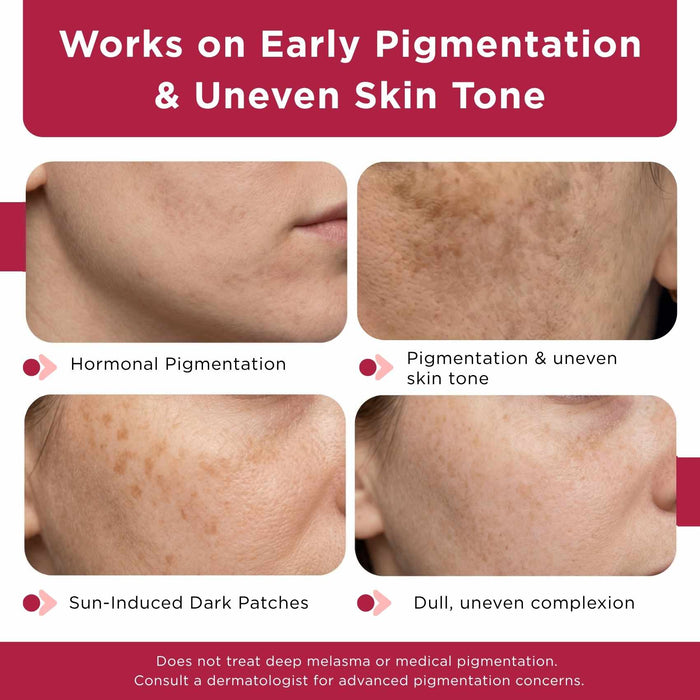 Early Onset Pigmentation 5 steps - Facewash+Corrector Serum+10% Vitamin Serum+Moisturising Cream+Sunscreen SPF50 - The Skin Story -