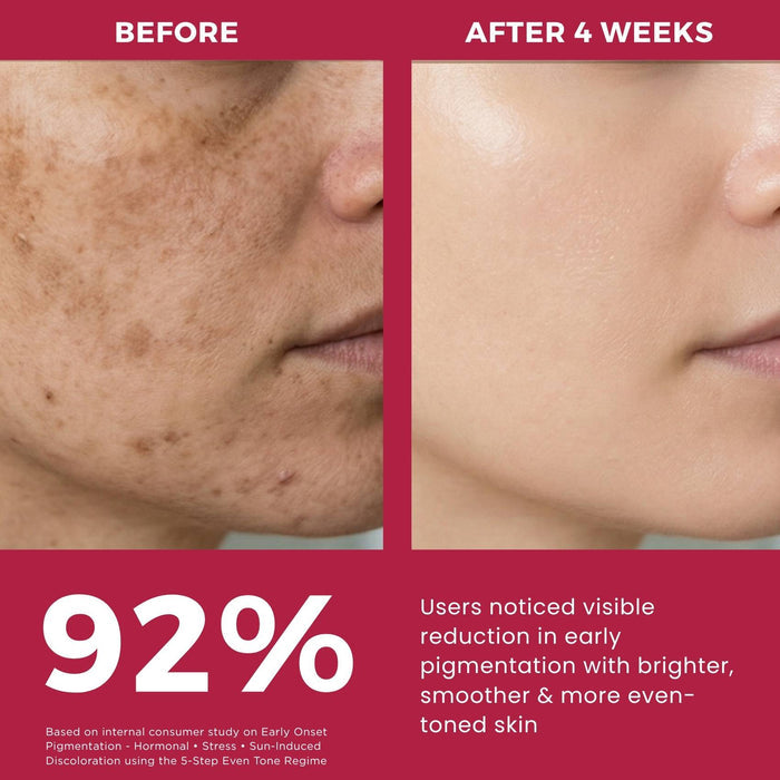 Early Onset Pigmentation 5 steps - Facewash+Corrector Serum+10% Vitamin Serum+Moisturising Cream+Sunscreen SPF50 - The Skin Story -