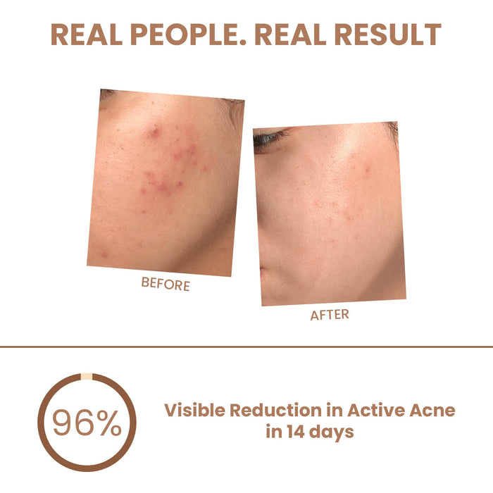 Pimple & Acne Corrector Gel - The Skin Story -