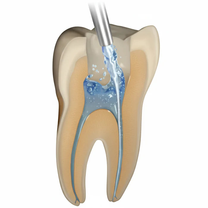 SafeEndo Smart Prep Liquid - 17% EDTA Root Canal Irrigation Solution